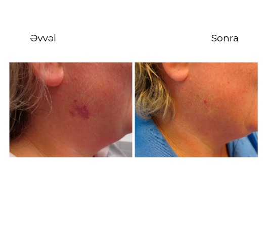 Candela Vbeam Perfecta